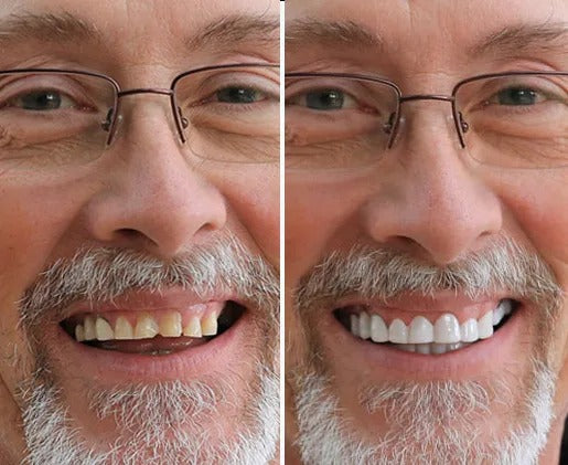 Calmfleece™ Snap-On Veneers