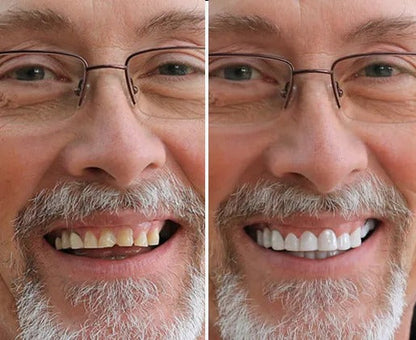 Calmfleece™ Snap-On Veneers